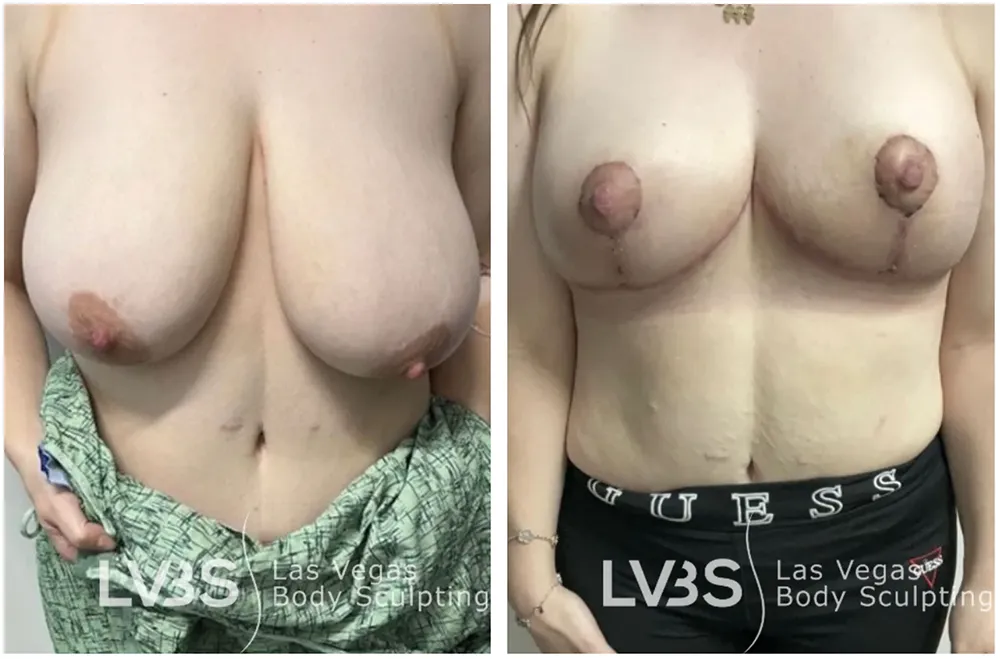 Breast lift before and after photos of Dr. Mustafa Ahmed's patient in Las Vegas.
