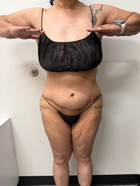 tummy-tuck-2