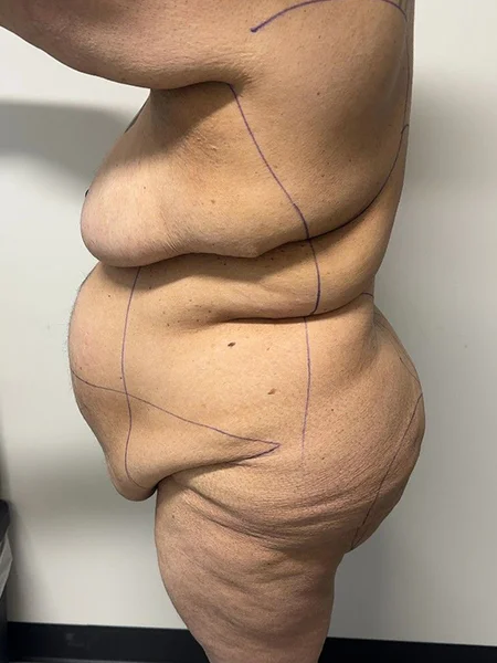 tummy-tuck-3