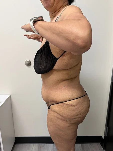 tummy-tuck-4
