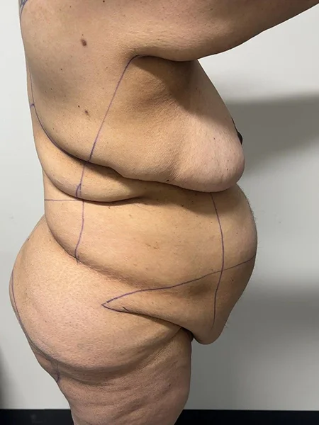 tummy-tuck-5
