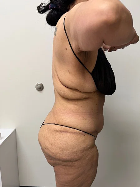 tummy-tuck-6
