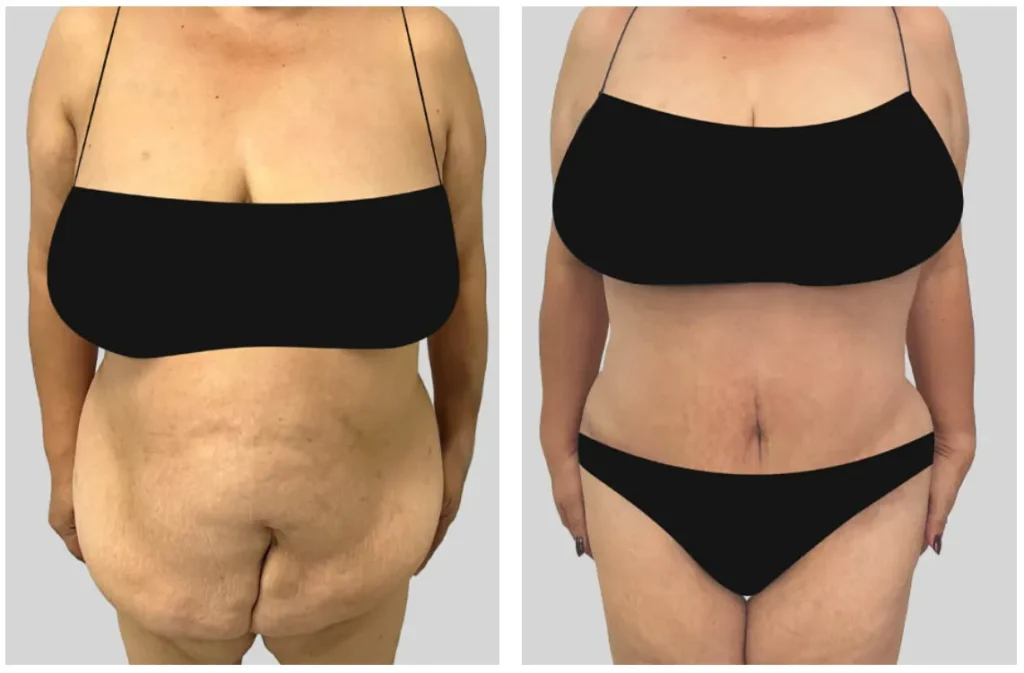 Before and After photo of a tummy tuck performed by renowned plastic surgeon Dr. Mustafa Ahmed in Las Vegas.