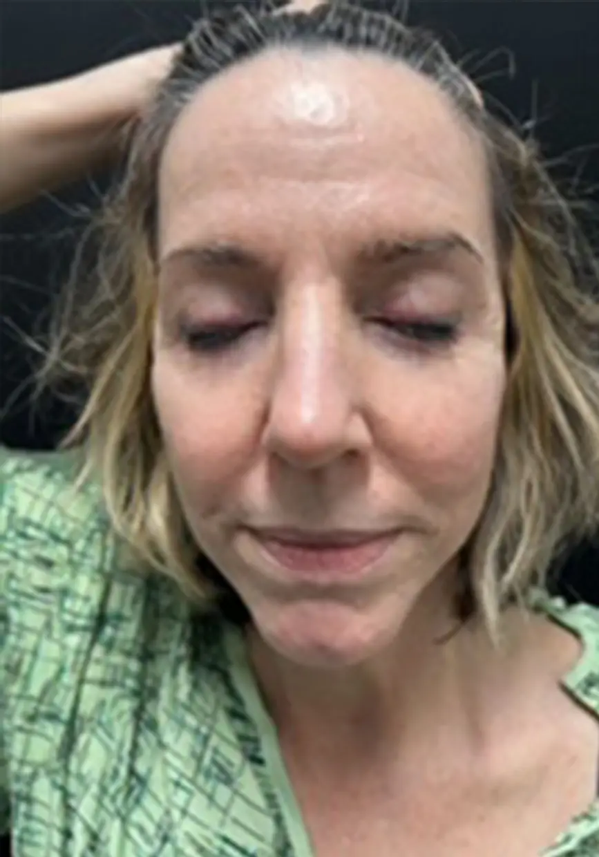 forehead-lift_AH_1of6