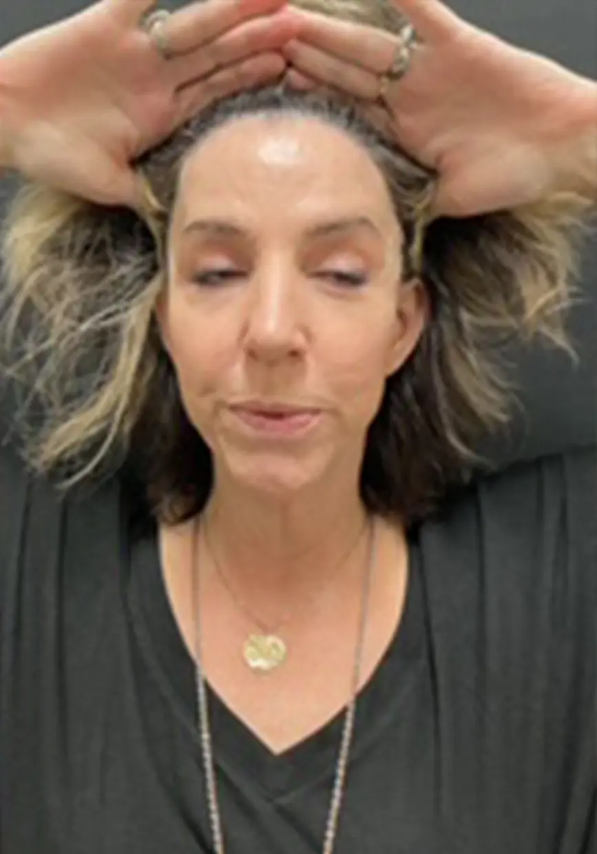 forehead-lift_AH_2of6