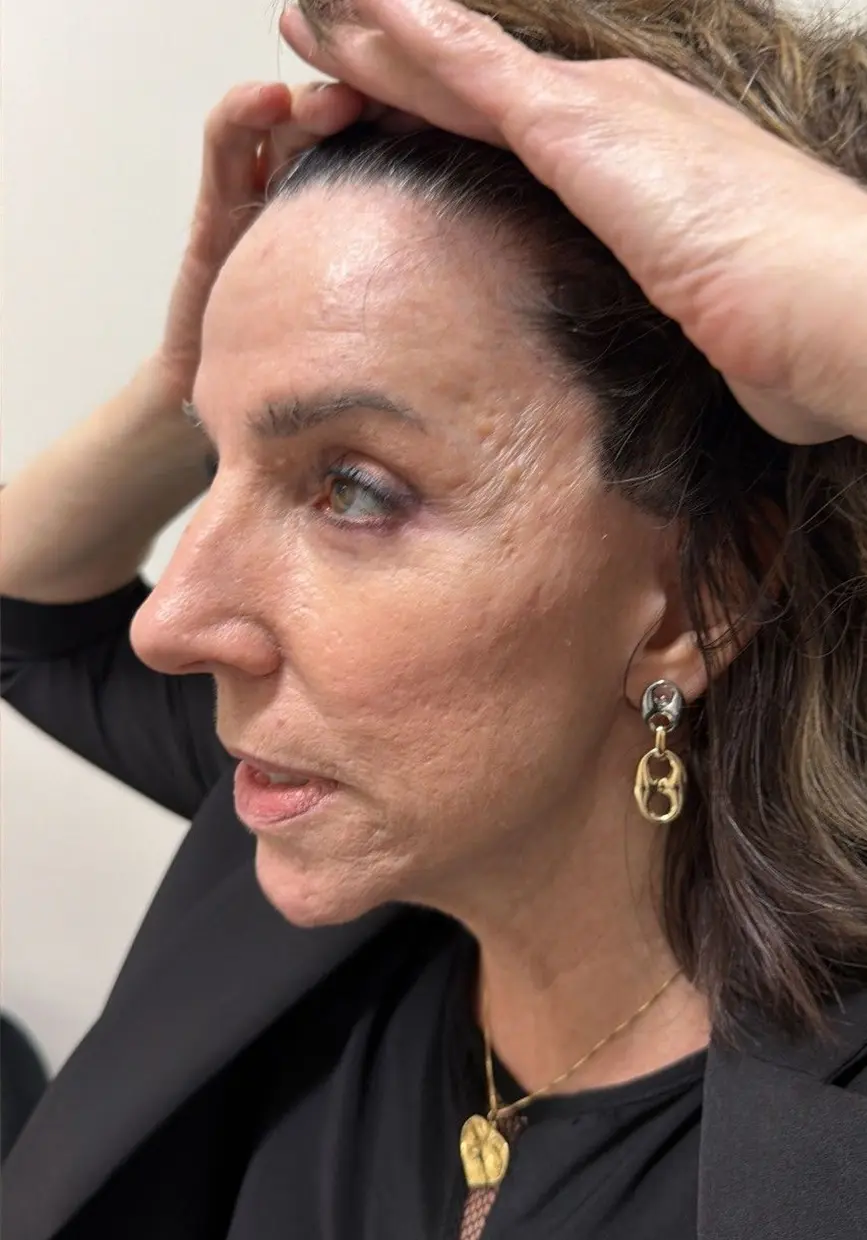 forehead-lift_AH_3of6