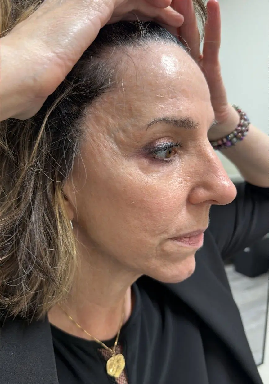 forehead-lift_AH_5of6