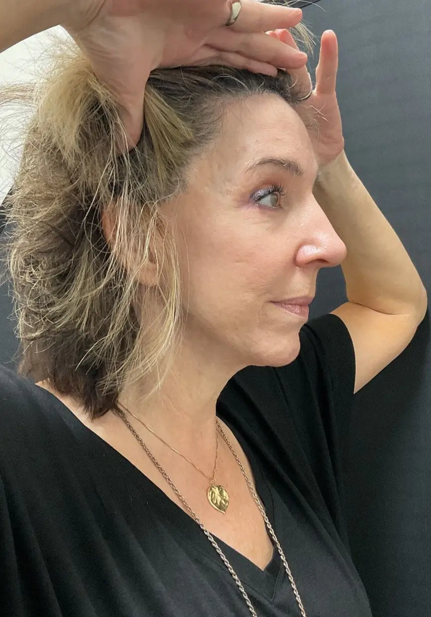 forehead-lift_AH_6of6