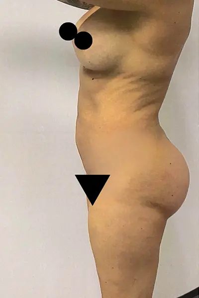 Brazilian Butt Lift before photo