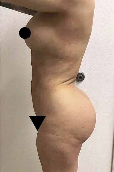 Brazilian Butt Lift after photo