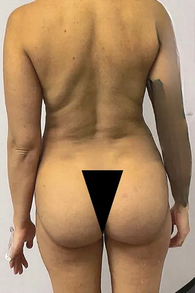 Brazilian Butt Lift before photo