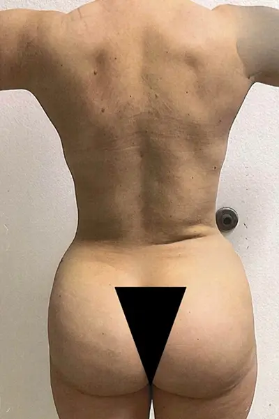 Brazilian Butt Lift after photo