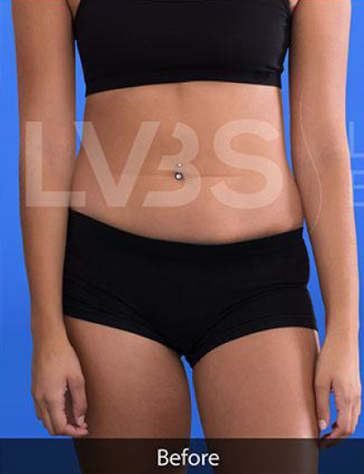 Liposuction Before & After Patient #344