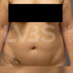 Liposuction Before & After Patient #373