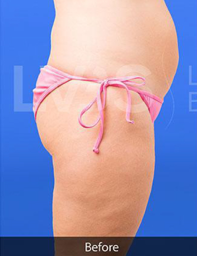 Liposuction Before & After Patient #349