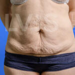 Liposuction Before & After Patient #360