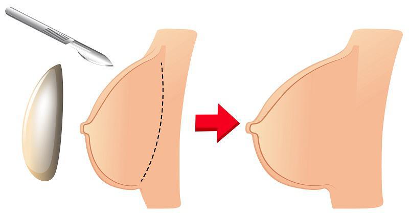 Lucy's Natural Looking Breast Enlargement - MyBreast