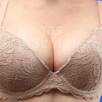 Breast Augmentation Before & After Patient #202