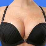 Breast Augmentation Before & After Patient #205