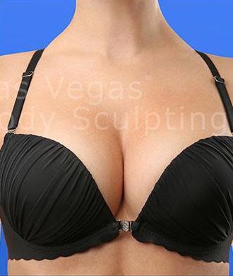 Breast Augmentation Before & After Patient #205
