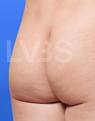 Brazilian Butt Lift (Fat Transfer to Butt) Before & After Patient #199