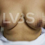 Breast Augmentation Before & After Patient #208