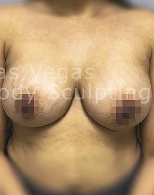 Breast Augmentation Before & After Patient #208