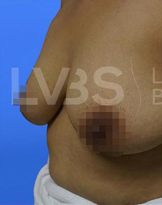 Breast Augmentation Before & After Patient #214