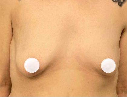 Breast Augmentation Before & After Patient #433