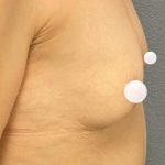 Breast Augmentation Before & After Patient #433