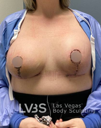 Breast Lift Before & After Patient #445
