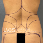 Brazilian Butt Lift (Fat Transfer to Butt) Before & After Patient #516