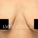 Breast Before & After Patient #513
