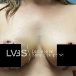Breast Before & After Patient #513