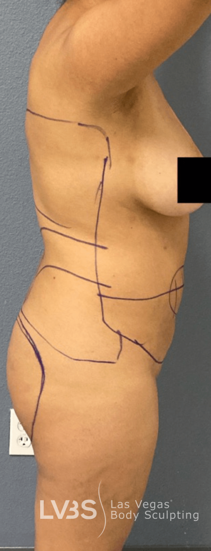 Brazilian Butt Lift (Fat Transfer to Butt) Before & After Patient #516