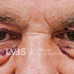 Blepharoplasty Before & After Patient #595