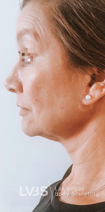 Facelift Before & After Patient #605