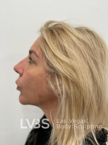 Lip Lift Before & After Patient #589
