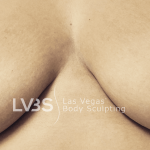 Breast Augmentation Before & After Patient #710