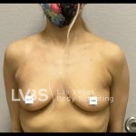 Breast Augmentation Before & After Patient #651