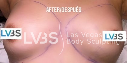 Fat Transfer to Breast Before & After Patient #671