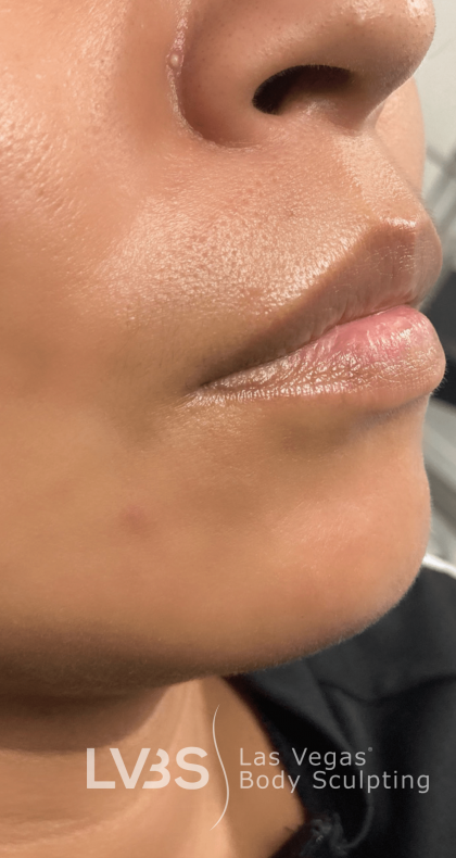 Lip Fillers Before & After Patient #722