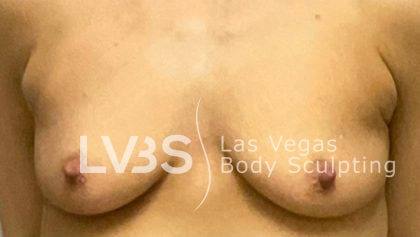 Breast Augmentation Before & After Patient #674