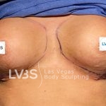 Breast Augmentation Before & After Patient #674