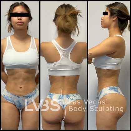 Brazilian Butt Lift (Fat Transfer to Butt) Before & After Patient #658