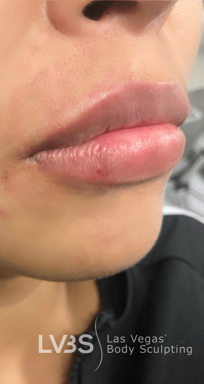 Lip Fillers Before & After Patient #722