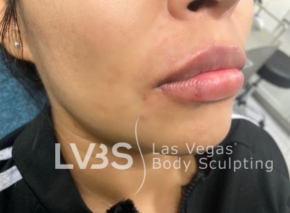 Lip Fillers Before & After Patient #643