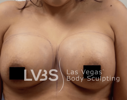 Fat Transfer to Breast Before & After Patient #655
