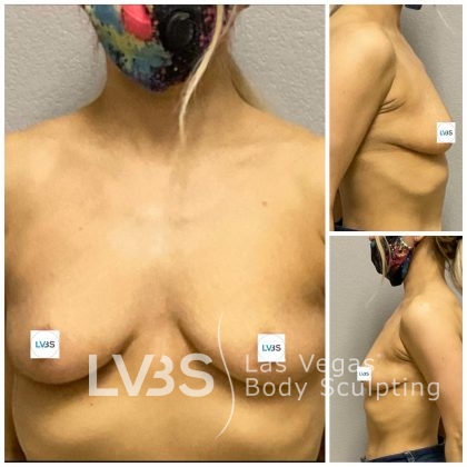Breast Augmentation Before & After Patient #677