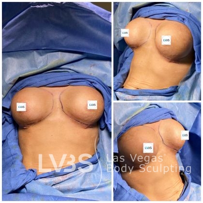Breast Augmentation Before & After Patient #677